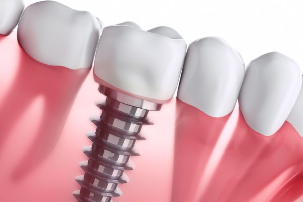 Gingivitis, mucositis y periimplantitis, los tres pilares de los implantes
