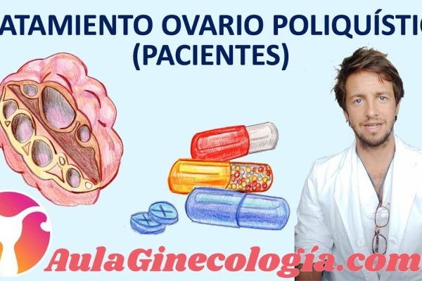 Cómo Manejar el Síndrome de Ovario Poliquístico Severo: Guía Completa y Consejos Prácticos