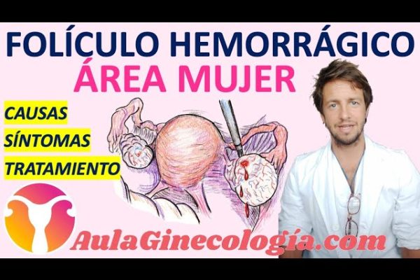 Cómo Manejar el Síndrome de Ovario Luteinizado Cíclico: Guía Completa para Aliviar Síntomas