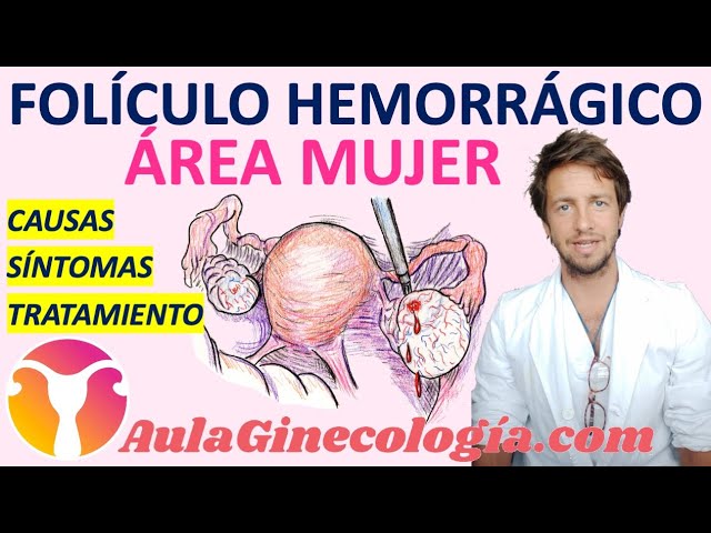 Como-manejar-el-sindrome-de-ovario-luteinizado-focal - Sonajero.es Cómo manejar el síndrome de ovario luteinizado focal