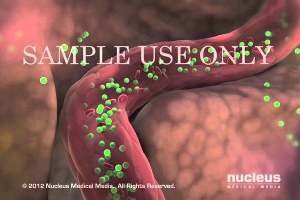 Cómo Manejar el Síndrome de Ovario Luteinizado Avanzado: Guía Completa y Efectiva