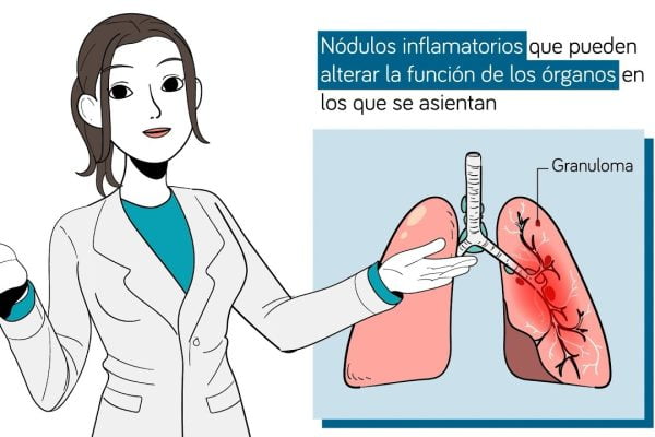 Sarcoidosis y salud ginecológica: Descubre la conexión que impacta tu bienestar