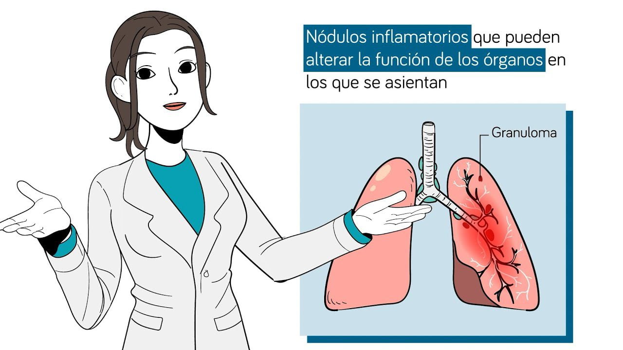 La relación entre la sarcoidosis y la salud ginecológica