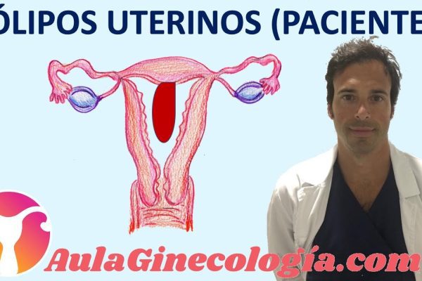 Todo lo que necesitas saber sobre la extracción de pólipos cervicales: Guía completa y consejos
