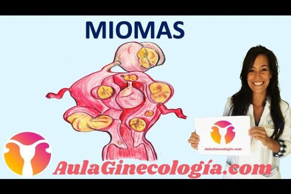 Todo sobre el diagnóstico y tratamiento del fibroma uterino: Guía completa y actualizada