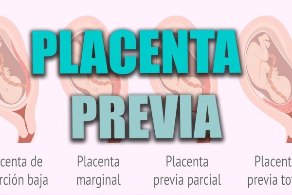 Todo sobre el Seguimiento del Embarazo con Placenta Previa: Guía Completa para Futuras Mamás