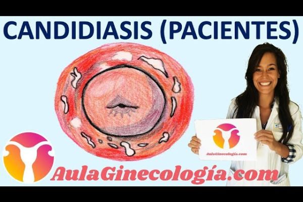 Cómo Prevenir y Tratar la Candidiasis Recurrente: Guía Completa y Efectiva