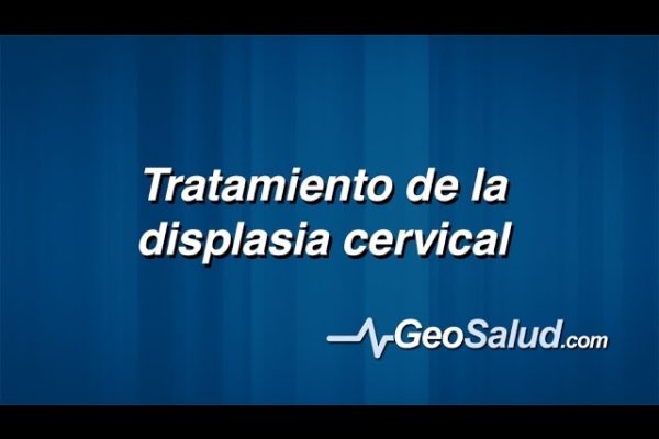 Cómo Prevenir y Tratar la Displasia Cervical: Guía Completa y Consejos Efectivos
