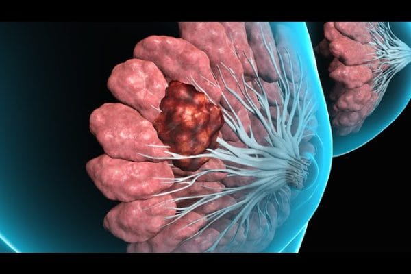 Todo lo que Necesitas Saber sobre la Biopsia de Mama: Procedimiento, Tipos y Resultados