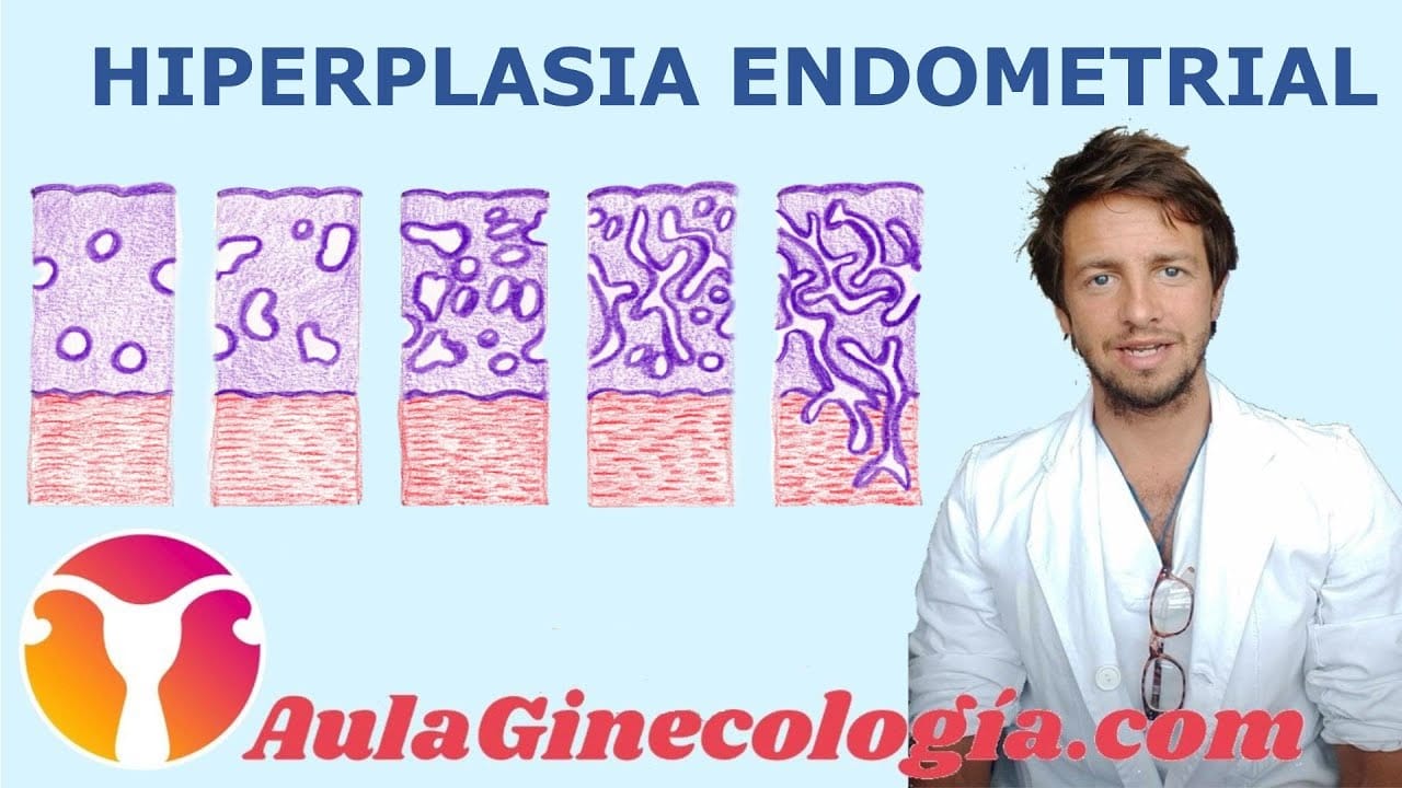 Como-manejar-la-hiperplasia-endometrial - Sonajero.es Cómo manejar la hiperplasia endometrial