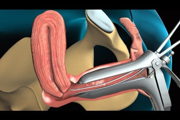 Todo lo que Necesitas Saber sobre la Biopsia Endometrial: Guía Completa y Consejos
