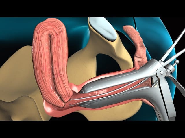 Todo-lo-que-necesitas-saber-sobre-la-biopsia-endometrial - Sonajero.es Todo lo que necesitas saber sobre la biopsia endometrial