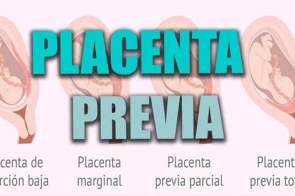Todo sobre el Seguimiento del Embarazo con Placenta Previa: Guía Completa y Consejos