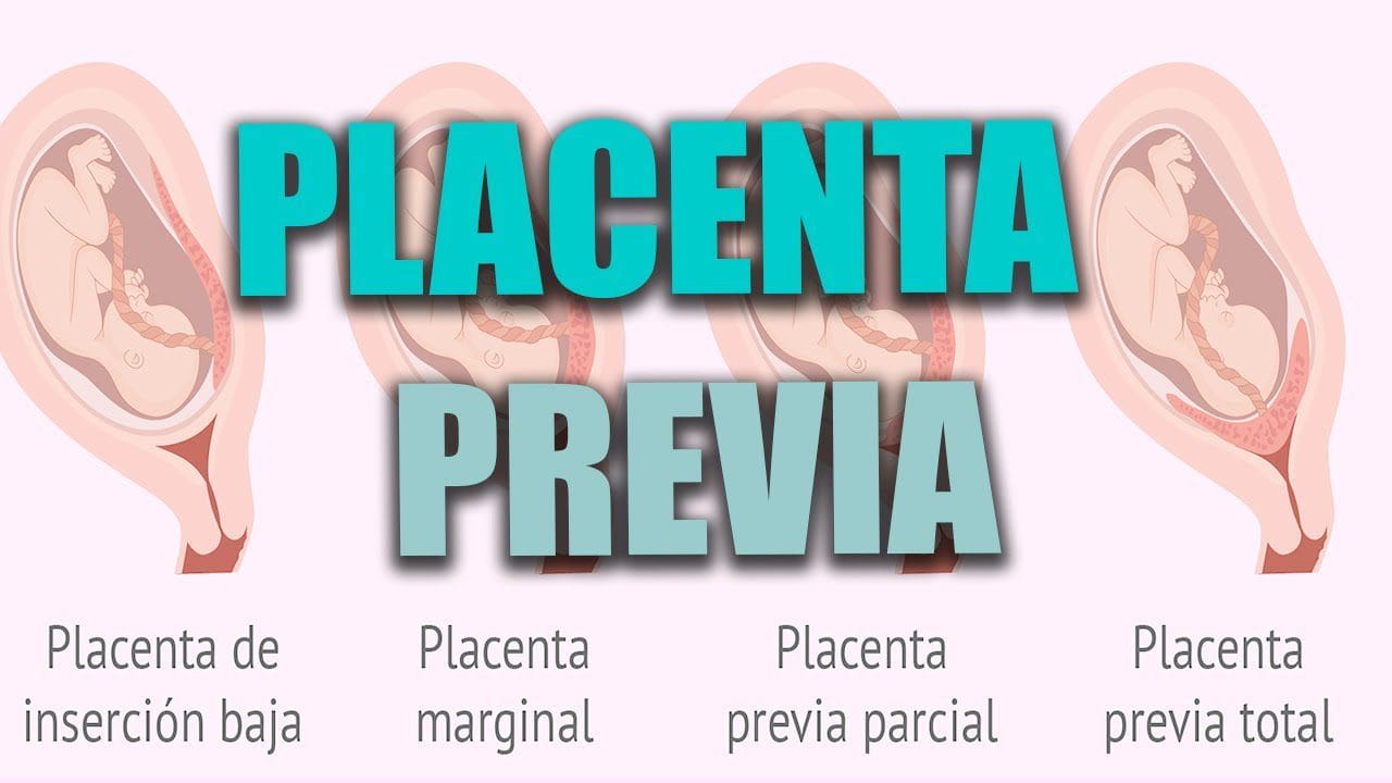 Todo-sobre-el-seguimiento-del-embarazo-con-placenta-previa - Sonajero.es Todo sobre el seguimiento del embarazo con placenta previa