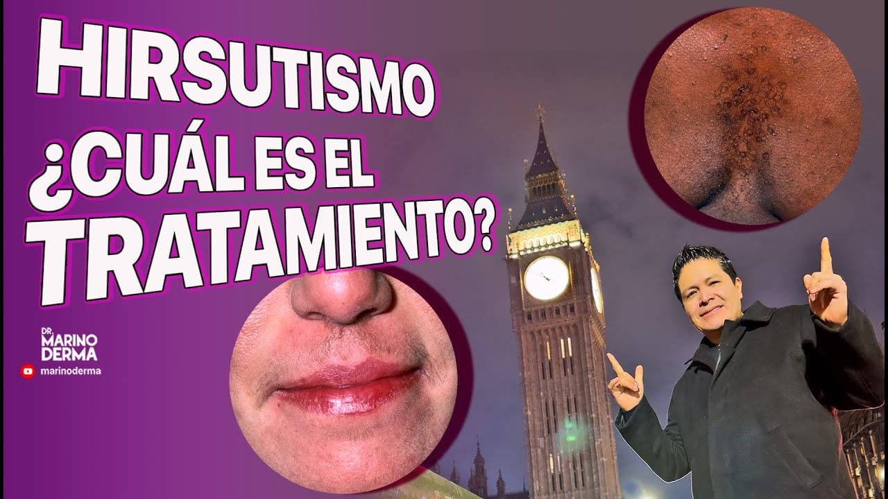 Todo-sobre-los-tratamientos-para-el-hirsutismo - Sonajero.es Todo sobre los tratamientos para el hirsutismo